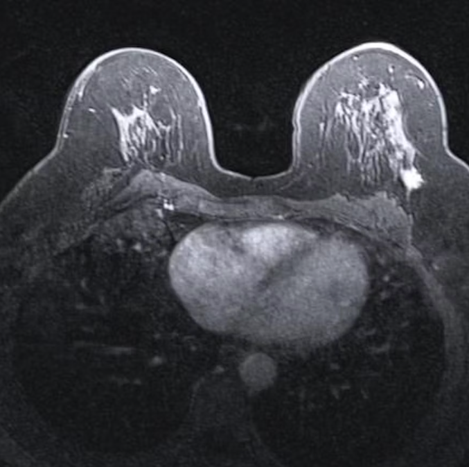 Featured image for “Most cancers detected on breast screening MRI are invasive”